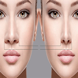 Rhinoplasty